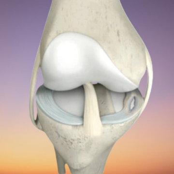 Knee Meniscus: Evidence Review & Axis Clinics Approach